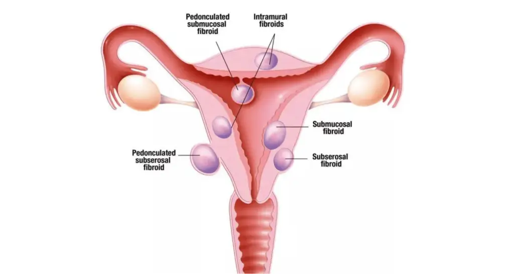 Types of fibroid